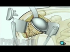 Shoulder Replacement PreOp® Patient Education Medical Videos